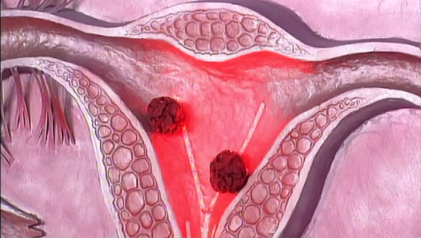 Симптомы рака матки