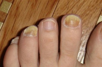 Как вылечить грибок ногтей на ногах фото