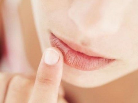 Герпес на губах – некрасивая болезнь
