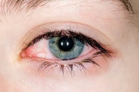 Красные белки глаз и отеки под глазами