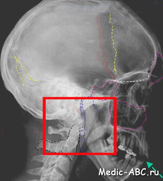 Чем опасен перелом основания черепа?