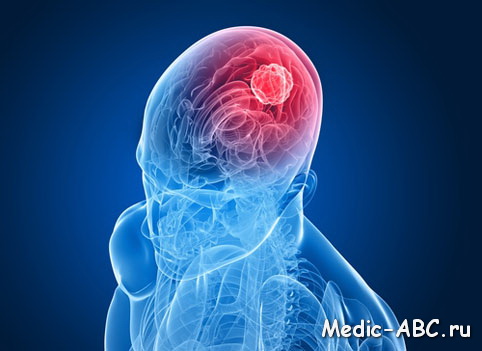 Что такое минингиома головного мозга?