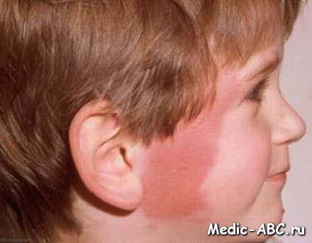 Что такое рожистое воспаление кожи?