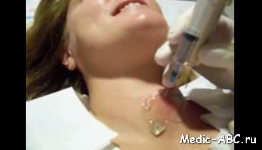 Как избавиться от узлов в щитовидной железе