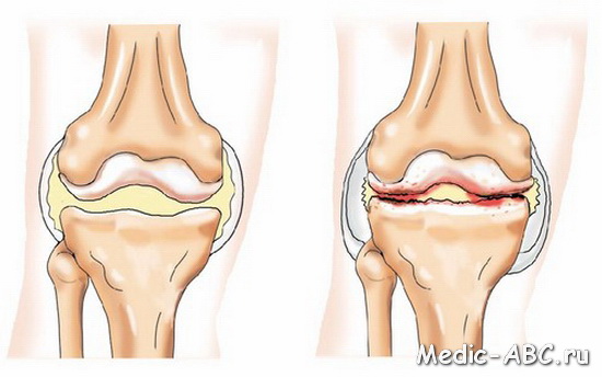 Как лечить артроз коленного сустава
