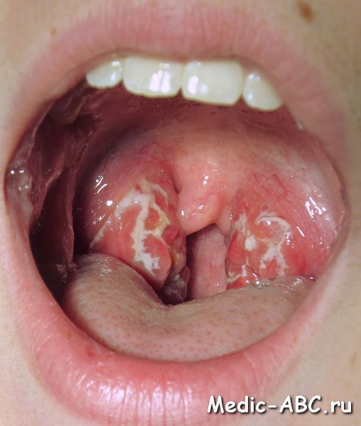 Как лечить горло и миндалины