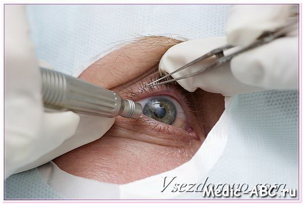 Как лечить отслоение сетчатки глаза