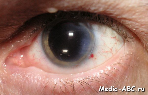 Как лечить синдром сухих глаз