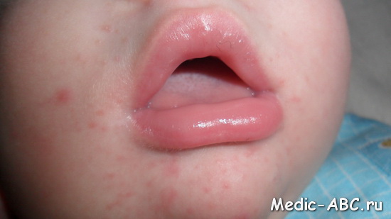 Опасна ли сыпь во рту?