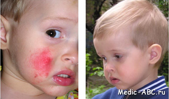 Особенности лечения аллергия на лице
