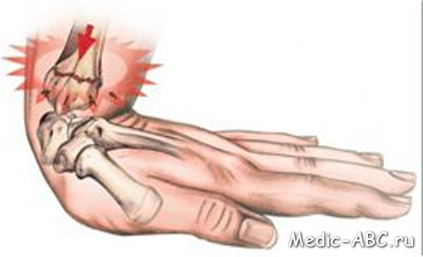 Перелом руки, симптомы и методы лечения