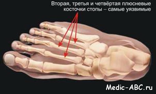 Переломы 5 плюсневой кости стопы