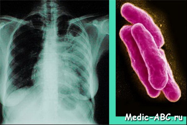 Симптомы туберкулёза