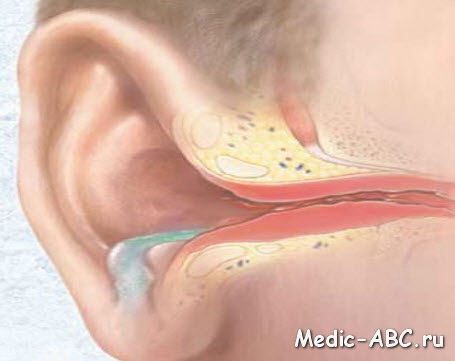 Воспаление уха при простуде, как избавиться от мучительной боли?